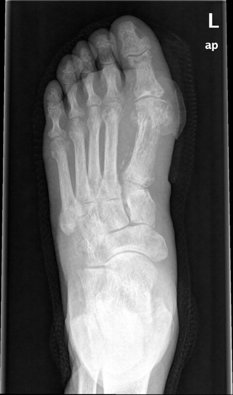 X-ray showing osteomyelitis of the first metatarsal head