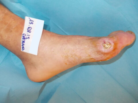 Preoperative first metatarsal head lesion