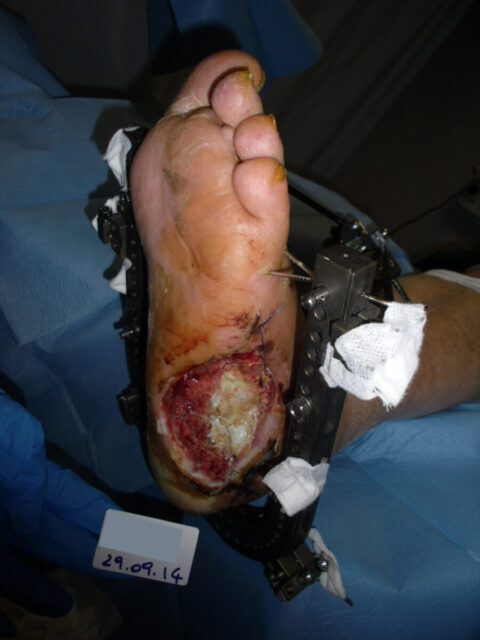Postoperative diabetic foot ulcer