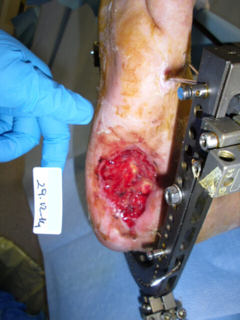 Postoperative diabetic foot ulcer at three months