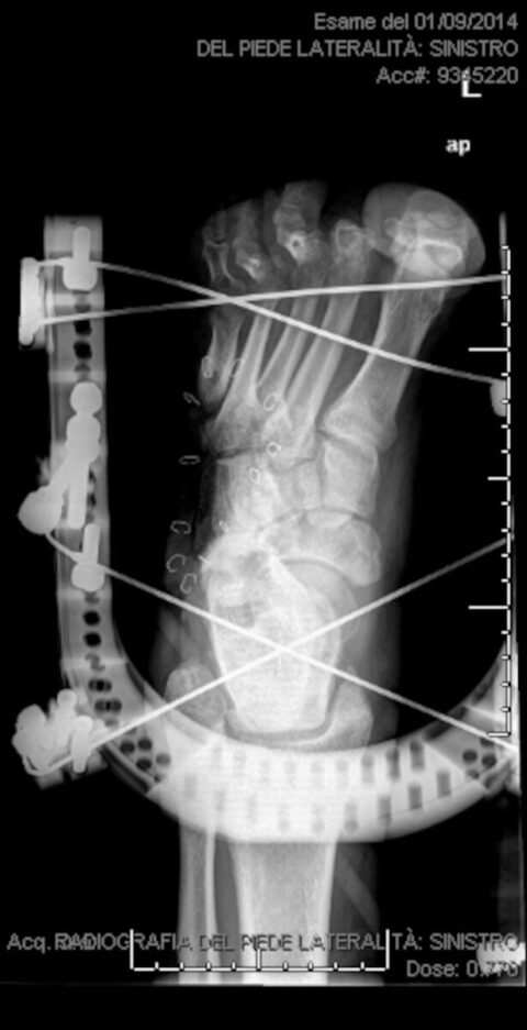 Postopertive X-ray