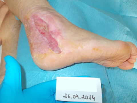 Diabetic foot heel ulcer