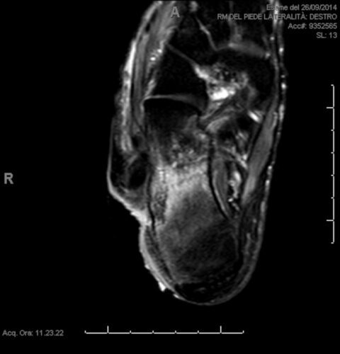 MRI showing infection after insufficient first surgical approach