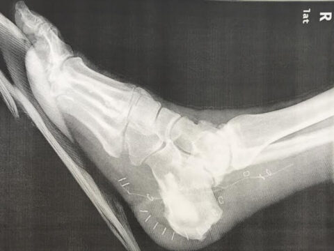 Postoperative diabetic foot X-ray
