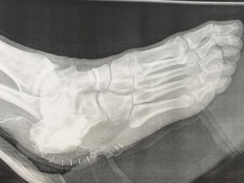 Postoperative diabetic foot X-ray