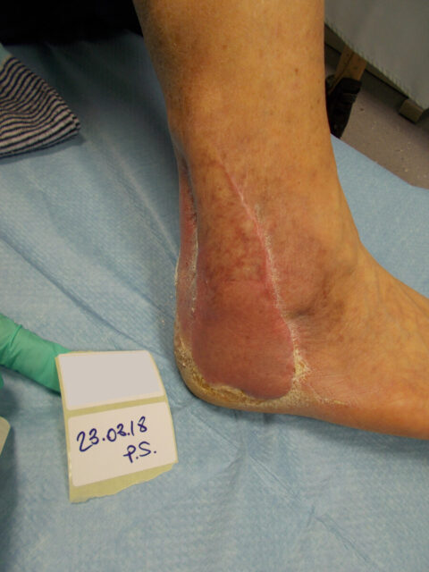 Four years after sural fasciocutaneus pedicled flap