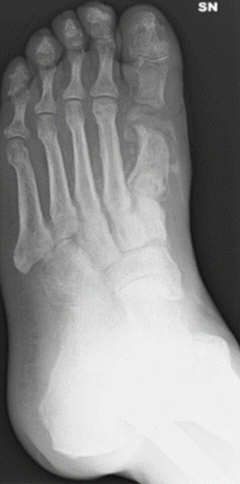 Radiographic outcome at 4 months 