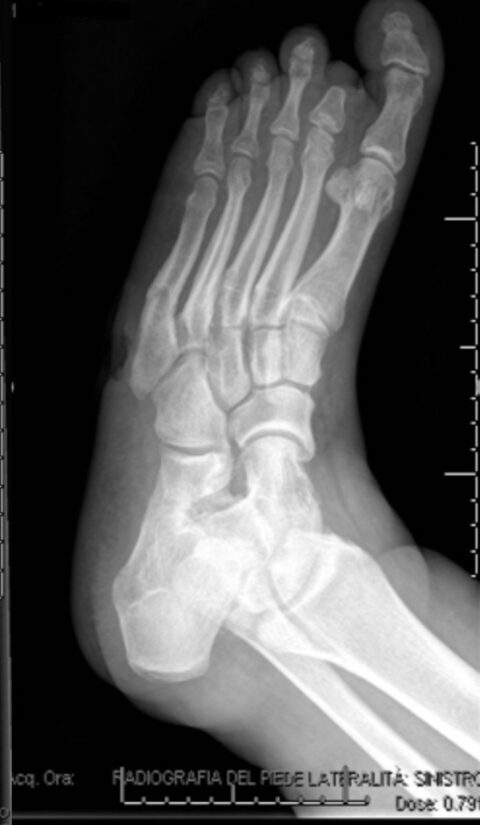 Preoperative X-ray showing the affected cuboid