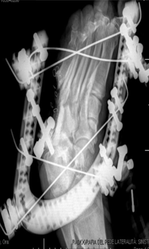 Postoperative X-ray