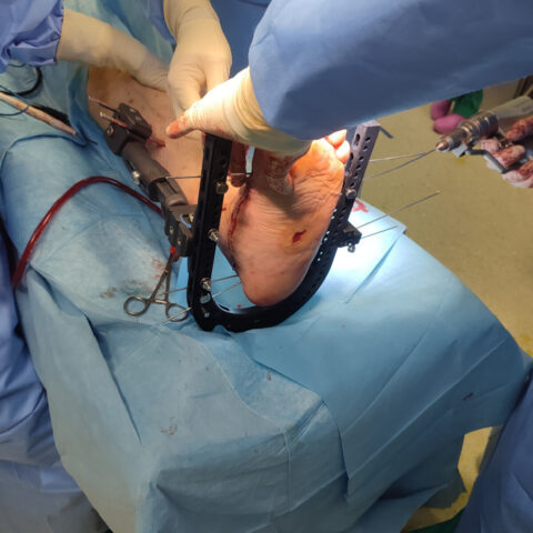 Artrodesi al piede: intervento di applicazione di un fissatore esterno-interno ibrido