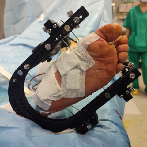Artrodesi al piede: post intervento di applicazione di un fissatore esterno-interno ibrido