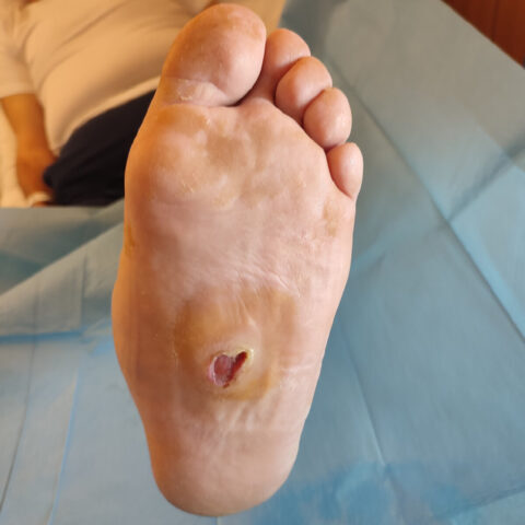 Artrodesi al piede: pre intervento di applicazione di un fissatore esterno-interno ibrido